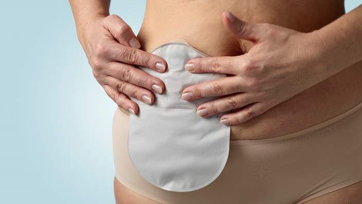 stoma afbeelding