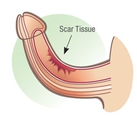 littekenweefsel op de penis
