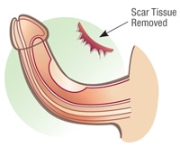 verwijdering van littekenweefsel op de penis