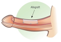 allotransplantaat allotransplantaat