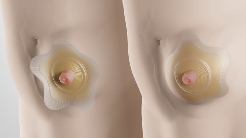 SenSura Mio Convex Flip voor mensen met een stoma op een bolling.