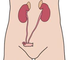 Urostoma of urinestoma