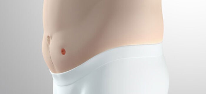Coloplast BodyCheck voor stomamateriaal